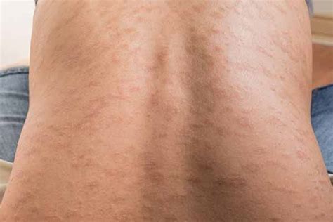 Orticaria: cause, sintomi, rimedi naturali e come ...