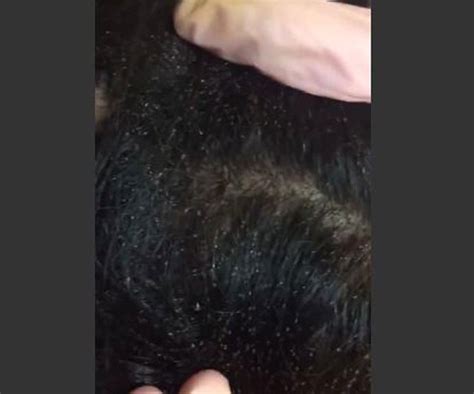 WATCH: Is this the worst head lice case you've seen ...