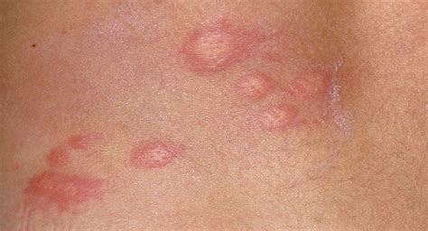 Papular Urticaria Babycenter