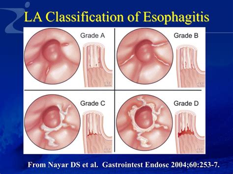 Infos Kesehatan Gastroesophageal Reflux Disease La Grade A