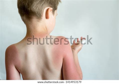 Sunblock Child Strong Sunburn Boys Sun Stock Photo Edit Now 1414953179