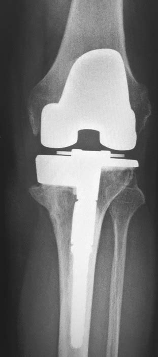 Conversion Of A Unicompartmental Knee Arthroplasty To A Total Knee