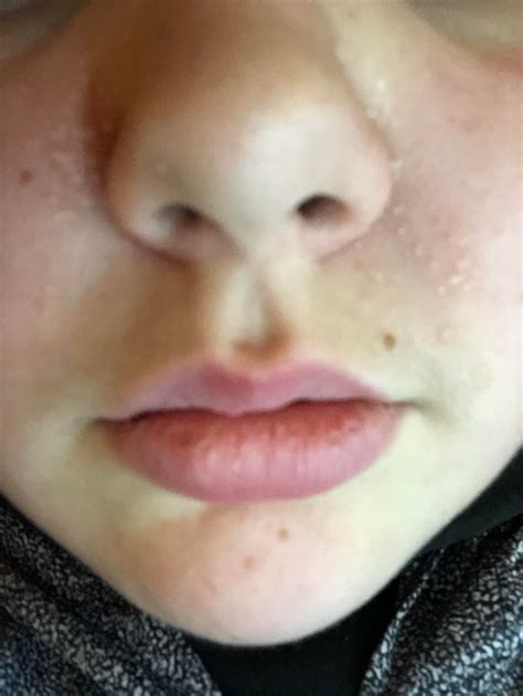 [Skin Concerns] 13 year old with peeling skin around nose that I don't ...