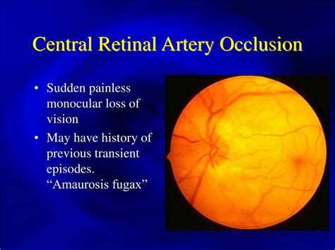 Central Retinal Artery Occlusion Dipolodesign