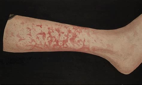 Erythema Marginatum Pictures Causes Signs And Symptoms Treatment