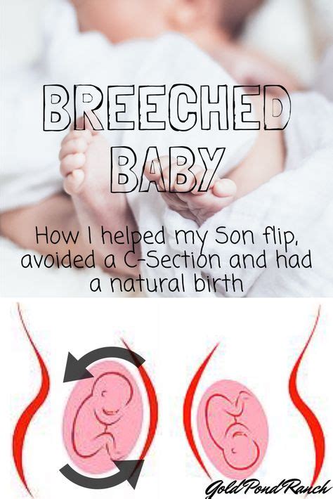 Ways To Turn A Breech Baby