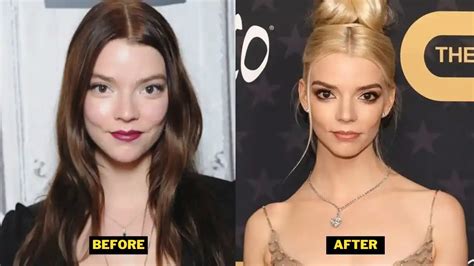 Anya Taylor Joy Plastic Surgery 2023 Before After Pictures Of Princess