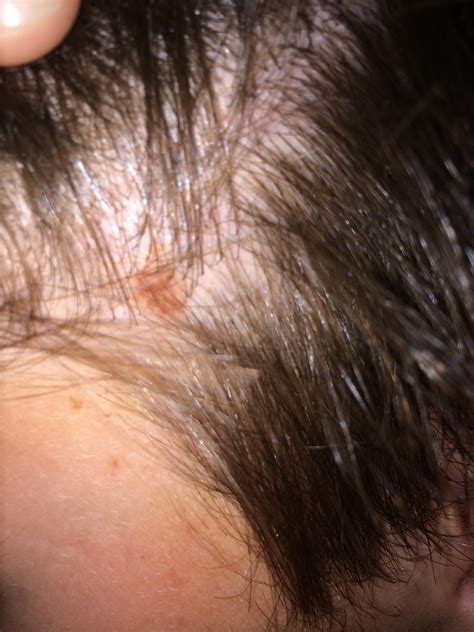 Small Spot On Scalp Not Itchy