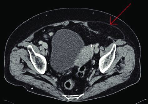 imagen de tomografía abdominal que muestra una hernia de spiegel download scientific diagram