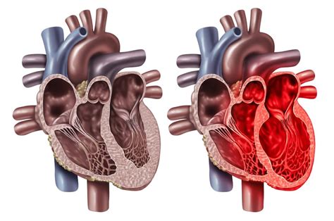 Broken Heart Syndrom So Gefährlich Ist Ein Gebrochenes Herz