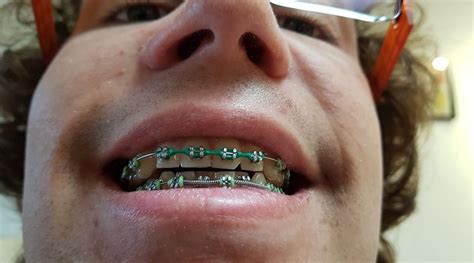 Mon Appareil Dentaire Avec Powerchain De Couleurs Verts Orthodontics Bracesjournal Broches