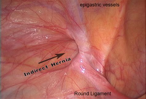 Inguinal Hernia Discussions On Hernia