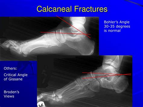 Ppt X Ray Rounds Plain Radiographic Evaluation Of The Ankle