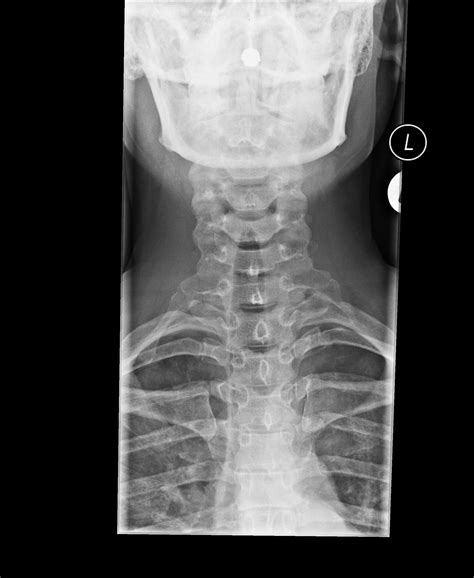 Bilateral Cervical Ribs Image