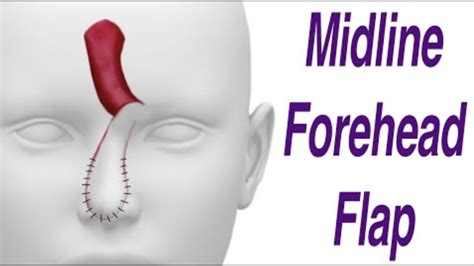 Midline Forehead Flap With Pictures Version 2 YouTube