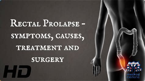 Rectal Prolapse Symptoms Causes Treatment And Surgery YouTube