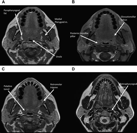 References In Pitfalls In The Staging Of Cancer Of The Oropharyngeal Squamous Cell Carcinoma