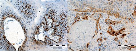 A Positive Nuclear Reaction Immunohistochemistry Ihc Performed Using