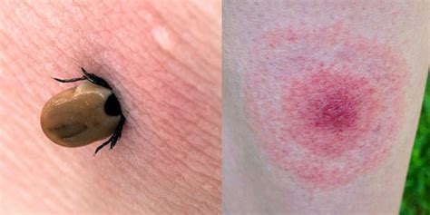 Bug Bites Pictures Symptoms Treatment And Prevention