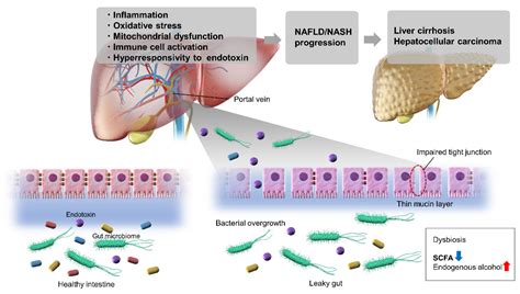 Ijms Free Full Text Current Research On The Pathogenesis Of Nafld