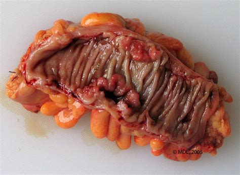 Ucsf colorectal surgeons have decades of experience and expertise in the most challenging and complex cases. Colon Cancer