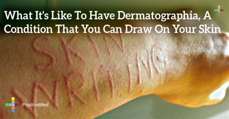 What Its Like To Have Dermatographia A Condition That You Can Draw