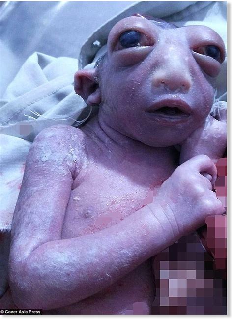 Signs And Portents Baby Girl Born With Only Half A Head
