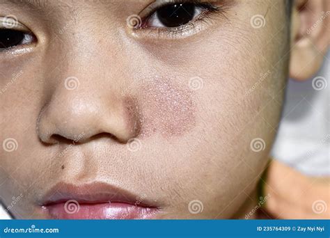 Tinea Faciei Or Fungal Infection On Face Of Asian Two Years Old Child