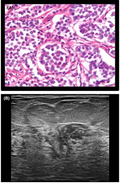 Histologic And Sonographic Appearance Of An Ill Defined Mass A