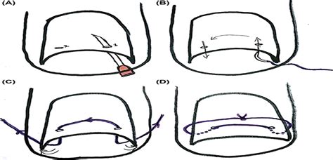 Suture Treatment For Pincer Nail Deformity An Inexpensive A