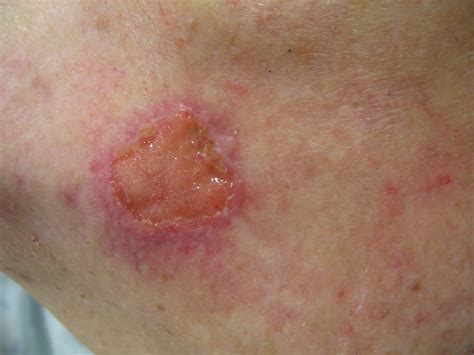 Early Squamous Cell Carcinoma Face