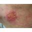 Squamous Cell Carcinoma Of The Skin  Clinical Advisor