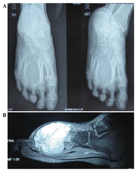 Aneurysmal Bone Cyst Of The Metatarsal A Case Report