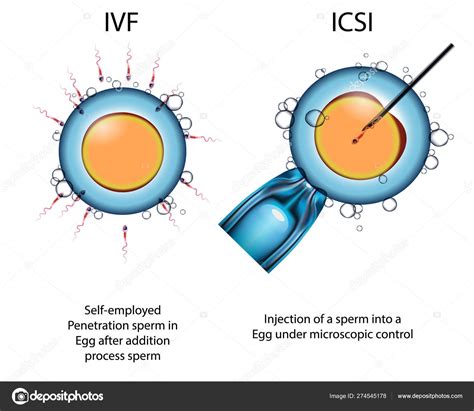 Types Of Artificial Fertilization Of The Egg By Sperm Eco Und Icsi