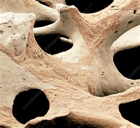 Coloured Sem Of Spongy Bone In Osteoporosis Stock Image M2300149
