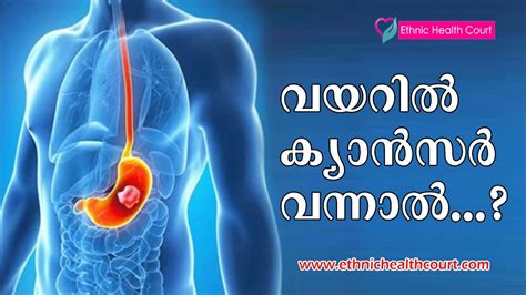 Stomach cancer, also known as gastric cancer, can affect any part of the stomach. Dangerous Symptoms of Stomach Cancer | Ethnic Health Court ...