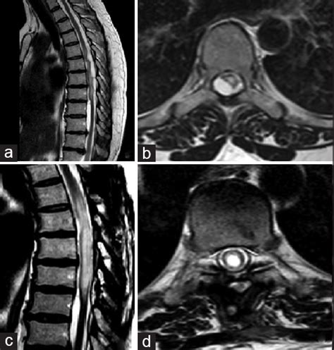 Intramedullary Cyst Formation After Removal Of Multiple Intradural
