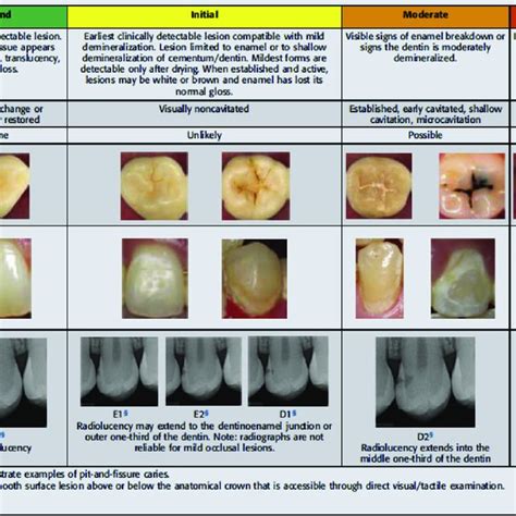 American Dental Association Caries Classification System Download