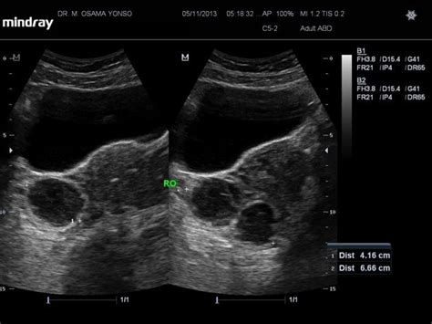Haemorrhagic Ovarian Cyst Radiology Case