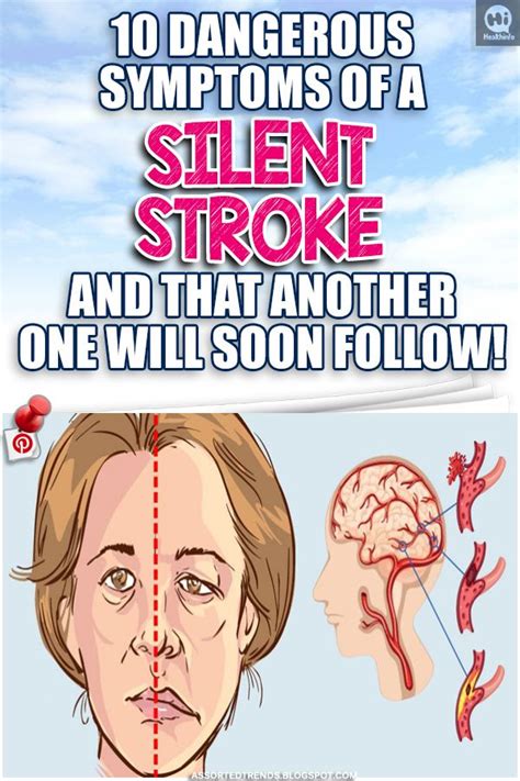 10 Dangerous Symptoms Of A Silent Stroke And That Another One Will Soon Follow Stroke