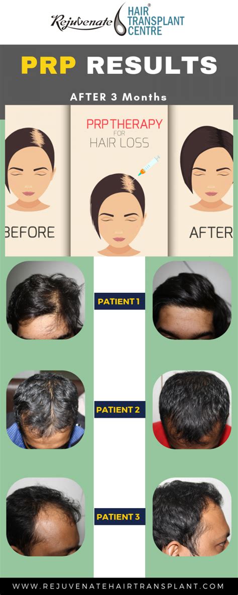 Result Of Prp Therapy In Hair Loss After Months Of Treatment