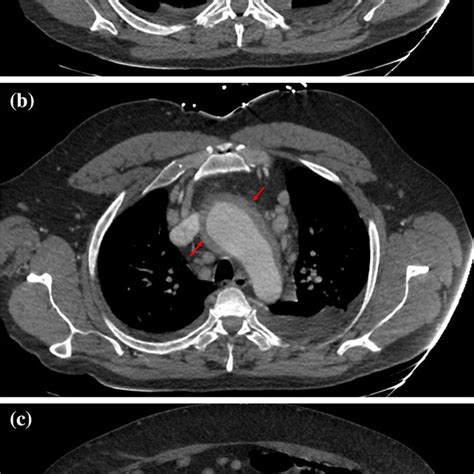 Transverse Images Of A Ct Angiogram Of Chest And Abdomen Revealing