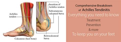 Achilles tendonitis occurs when the tendon that attaches the calf muscles to the heel becomes painful or inflamed. Achilles Tendonitis - The Complete Guide to Causes ...