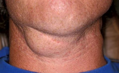 Lump Under Chin Bone Near Throat Neck Cancer Cold Sore Right Or Left Side Hurt Painful