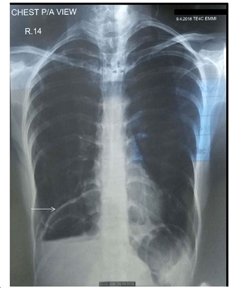 Plain Postero Anterior Chest X Ray Showing Abnormal Air Fluid Level