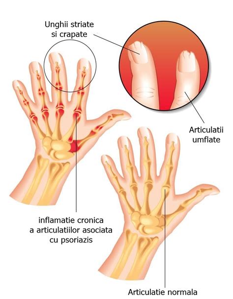Artrita Psoriazica Cauze Simptome Tratament Sfaturimedicale Ro My XXX