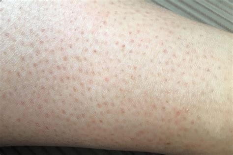 間違った脱毛は毛穴のブツブツや黒ずみの原因に!