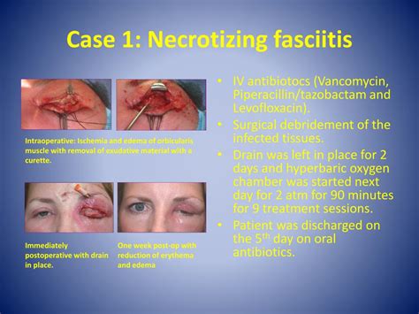 Ppt Treatment Of Periocular Necrotizing Fasciitis And Mucormycosis