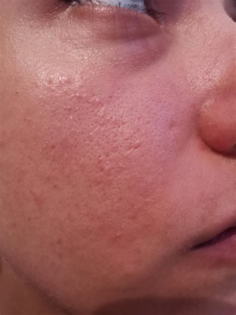 Acne Need Help With Acne And Large Pores Skincareaddiction
