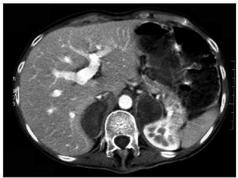 Abdominal Ct Scan Showing Asymmetrically Enlarged Adrenal Glands Right